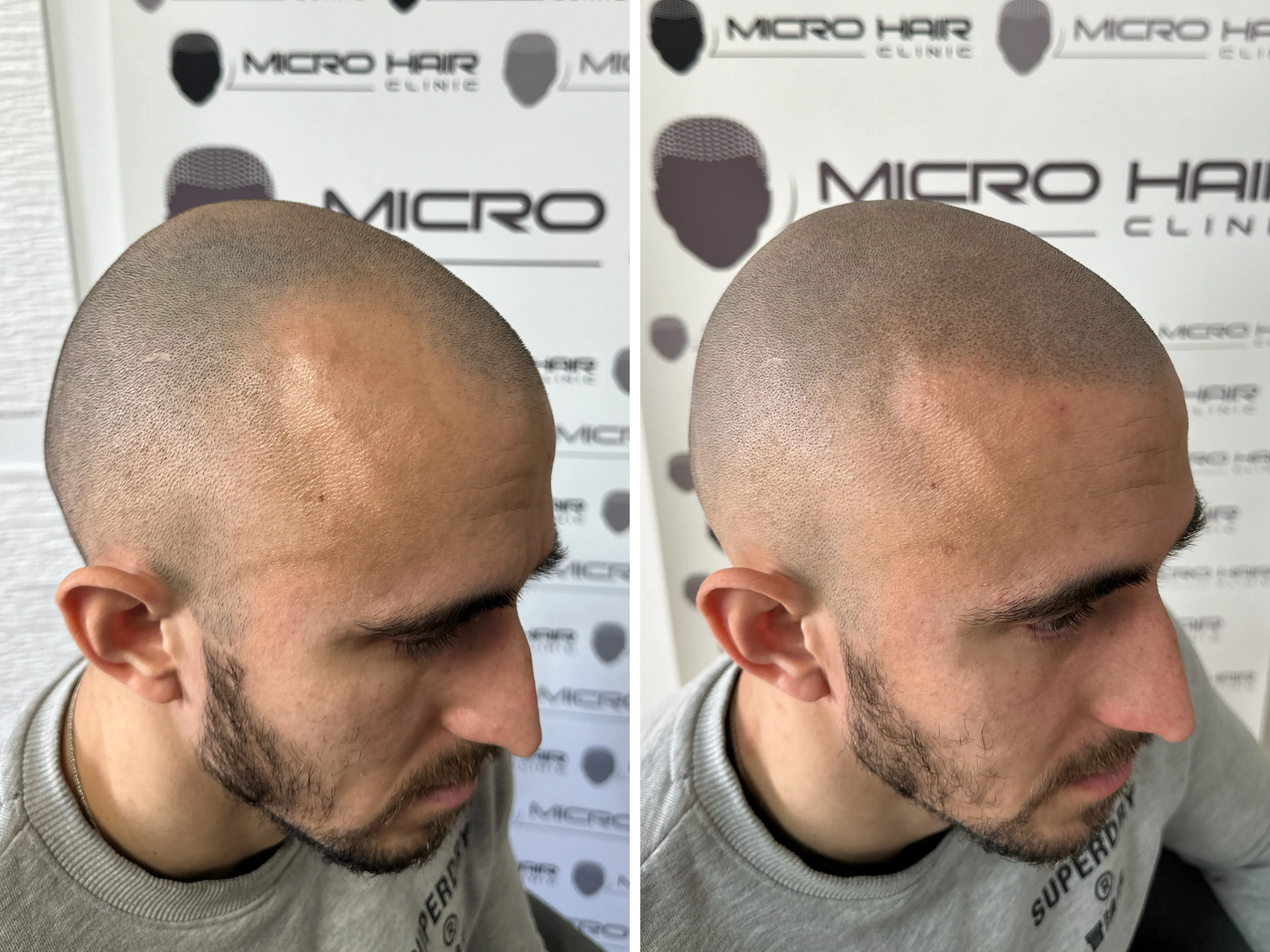 SMP rezultat pred in po - tretman mikropigmentacije 4